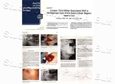 Ectopic Third Molar