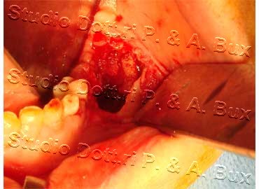 Odontoma