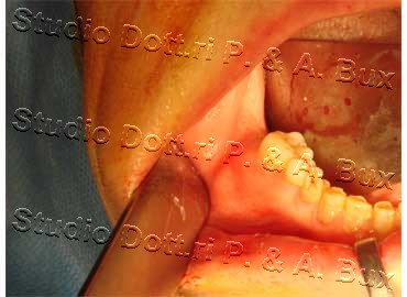 Odontoma