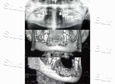 Osteonecrosi da Bifosfonati