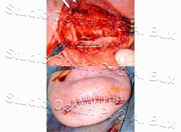 Osteonecrosi da Bifosfonati