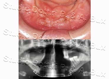 Osteonecrosi da Bifosfonati