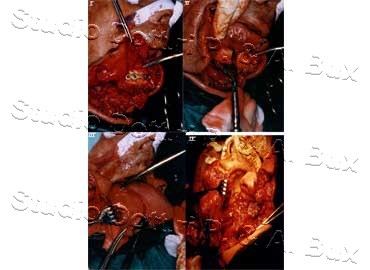 Carcinoma Lingua