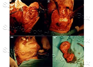 Carcinoma Lingua