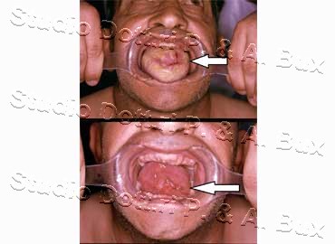 Carcinoma Lingua