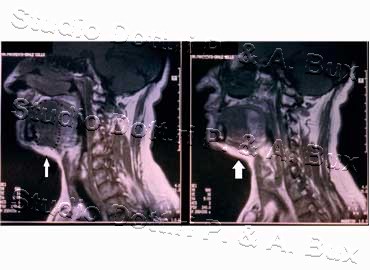 Carcinoma Lingua Bari