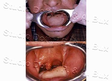 Carcinoma Lingua Bari