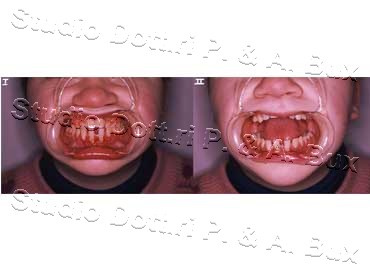 Macroglossia