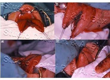 Macroglossia