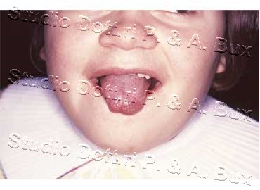 Macroglossia