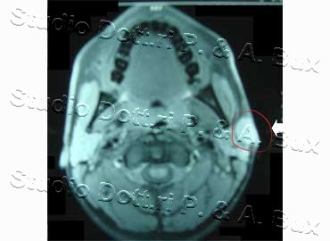 Pilomatricoma Parotide