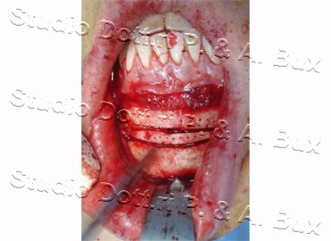 Mentoplastica Riduttiva Bari