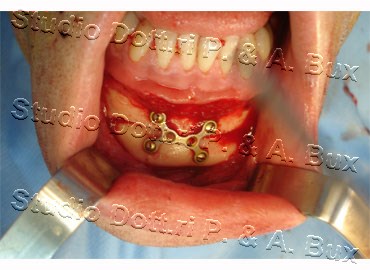 Mentoplastica Riduttiva Bari