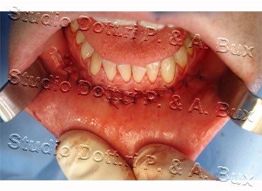 Mentoplastica Riduttiva Bari