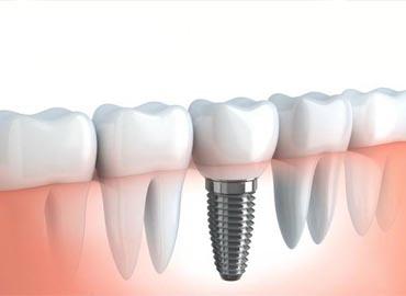 Implantologia Dentale Bux Bari