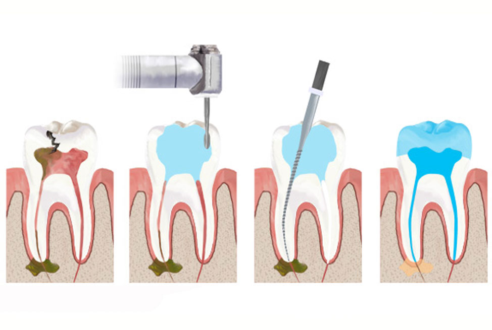 Endodonzia bari