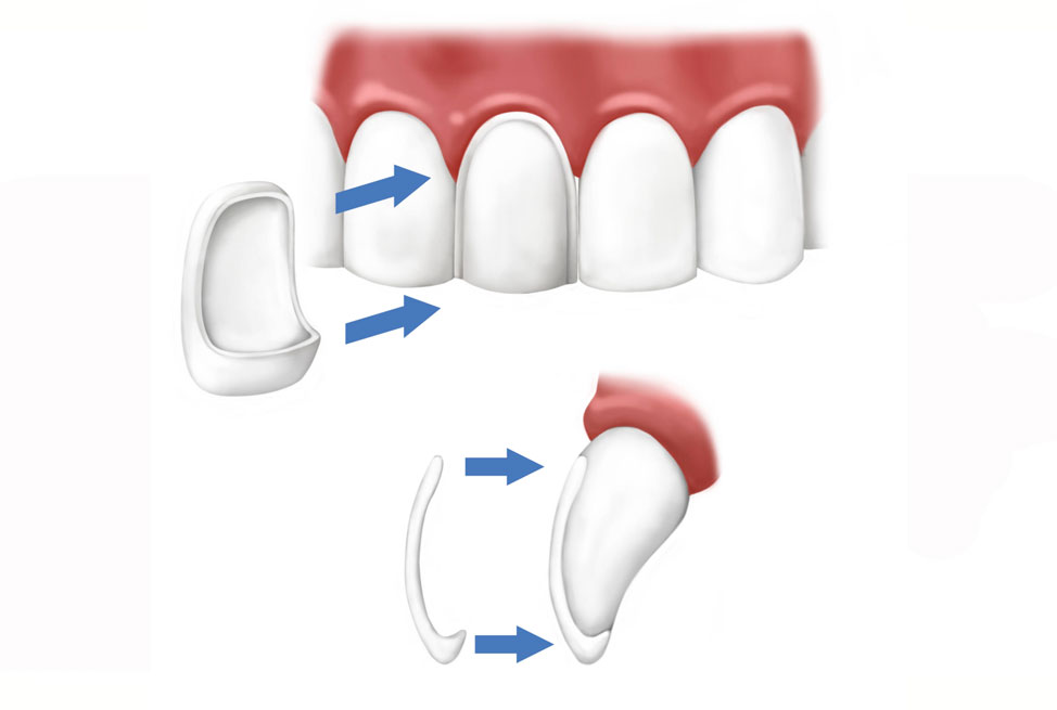 Faccette dentali Bari