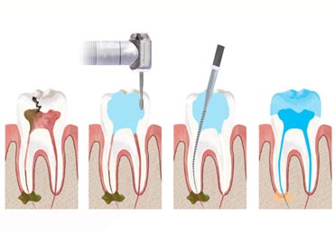 Endodonzia